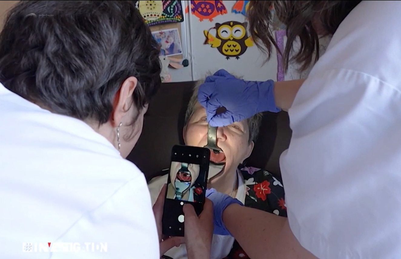 Vue intraorale élargie de la cavité buccale obtenue avec l’Odontoscope dans un EHPAD.