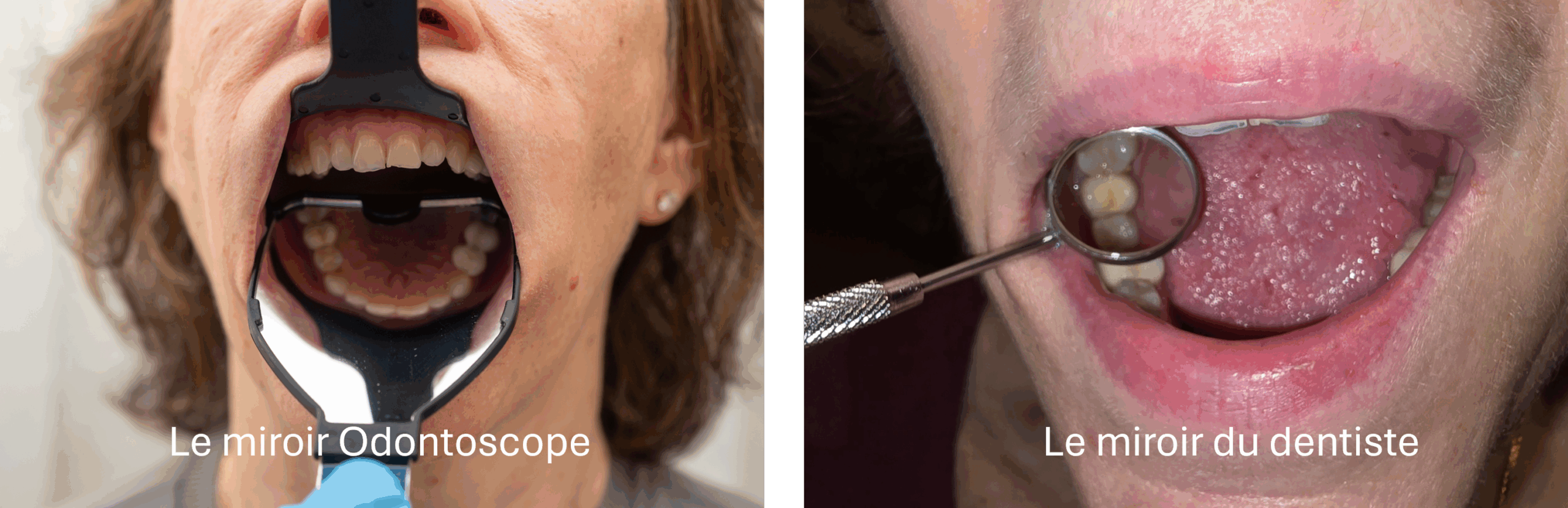 Le miroir buccal classique : un outil très précis, mais pensé pour le cabinet dentaire Le miroir traditionnel fonctionne parfaitement lorsque le dentiste travaille en bouche avec une lumière puissante, une aspiration efficace et une coopération du patient. Il permet d’observer une dent, une muqueuse ou un détail précis, en orientant la lumière et en contrôlant chaque mouvement. En dehors du cabinet, son utilisation devient toutefois plus délicate. Son champ de vision est réduit et son maniement demande une certaine dextérité. Chez une personne âgée, parfois alitée, souffrant de sécheresse buccale ou peu coopérante, il peut facilement provoquer un inconfort. Le soignant est souvent obligé d’écarter manuellement les joues et les lèvres, ce qui complique la réalisation de l’examen. Par ailleurs, pour photographier la bouche dans le cadre d’une téléexpertise, le petit miroir provoque souvent des reflets et ne permet pas de capturer une image exploitable. En maison de repos, les conditions ne sont donc pas les mêmes qu’au fauteuil dentaire : l’éclairage est limité, le temps est compté, et la coopération peut être faible. Le miroir classique atteint alors ses limites. L’Odontoscope® : un miroir conçu pour l’examen visuel en institution L’Odontoscope® a été développé pour répondre précisément à ces contraintes. Il associe une large surface réfléchissante et une forme qui écarte naturellement les lèvres et les joues. Cette combinaison permet d’obtenir en un seul geste une vue complète de l’arcade dentaire, sans devoir manipuler plusieurs instruments. Son ergonomie a été pensée pour que le personnel soignant puisse l’utiliser sans formation technique complexe. Il suffit de placer l’outil dans la bouche pour obtenir immédiatement une image panoramique qui révèle l’état général des dents, des gencives ou des prothèses. Cette vision élargie rend l’examen plus rapide, plus confortable pour le résident et plus fiable pour celui qui l’effectue. L’Odontoscope® facilite également la prise de photographies standardisées. Le miroir réduit les reflets et permet de capter, avec un simple smartphone, une image claire qui peut être transmise au dentiste pour une téléexpertise. Ce point est particulièrement utile dans les maisons de repos, où la disponibilité du dentiste n’est pas immédiate et où l’évaluation à distance aide à décider si une consultation est nécessaire. Comparaison entre les deux dispositifs Le miroir classique excelle dans la précision, mais il reste un instrument technique conçu pour un environnement contrôlé. Il est idéal pour un examen extrêmement ciblé, réalisé par un dentiste. L’Odontoscope®, à l’inverse, privilégie une vision globale, une simplicité d’usage et un confort supérieur pour les résidents âgés. En institution, les soignants doivent pouvoir observer rapidement l’état buccal global, identifier une inflammation, une ulcération, une prothèse instable ou un signe de douleur. Ils doivent aussi pouvoir documenter cet examen visuel à l’admission, lors du suivi ou en cas de plainte. L’Odontoscope® facilite ces étapes, puisqu’il permet de réaliser l’observation en quelques secondes et de conserver une trace photographique cohérente d’un examen à l’autre. Le miroir classique reste utile lorsque c’est le dentiste lui-même qui examine ou traite une zone spécifique. L’Odontoscope® devient l’outil de référence dès qu’il s’agit d’un examen visuel rapide, reproductible et accessible, dans un contexte institutionnel ou de téléexpertise.