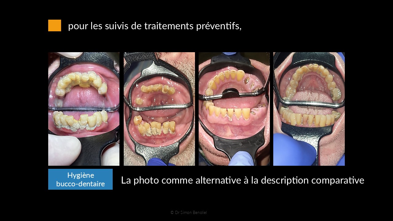 Images intraorales prises avec l’Odontoscope montrant des niveaux d’hygiène bucco-dentaire chez des résidents en EHPAD.
