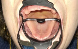 Vue intraorale élargie de la cavité buccale obtenue avec l’Odontoscope dans un EHPAD. Titre d’image