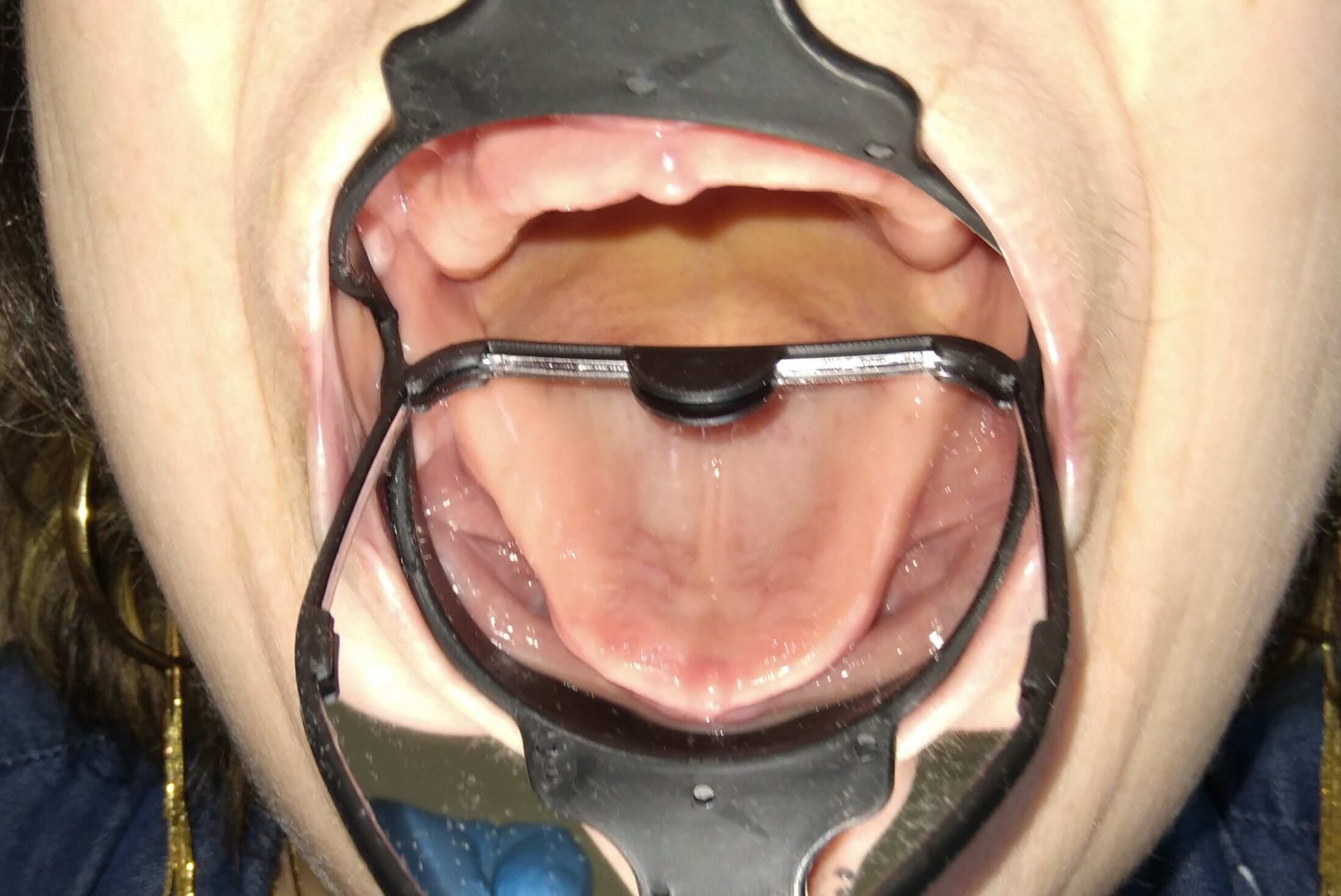 Vue intraorale élargie de la cavité buccale obtenue avec l’Odontoscope dans un EHPAD. Titre d’image